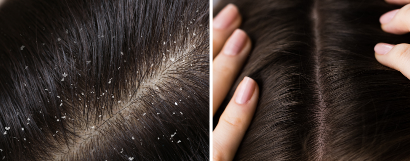 Say Goodbye to Scalp Problems with the Best Scalp Treatment in Singapore